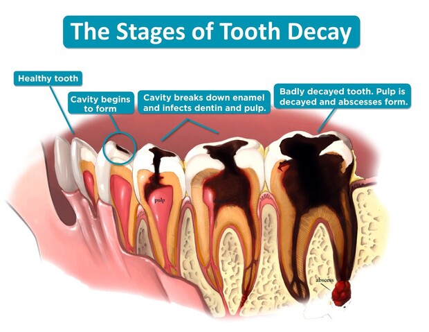 What Are The Stages Of Dental Cavity?