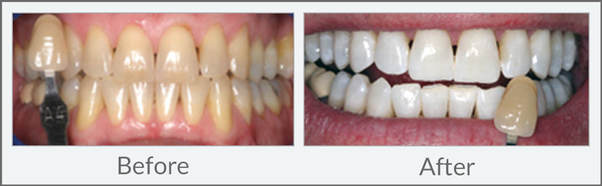 Teeth Whitening - DENTAL EXCELLENCE